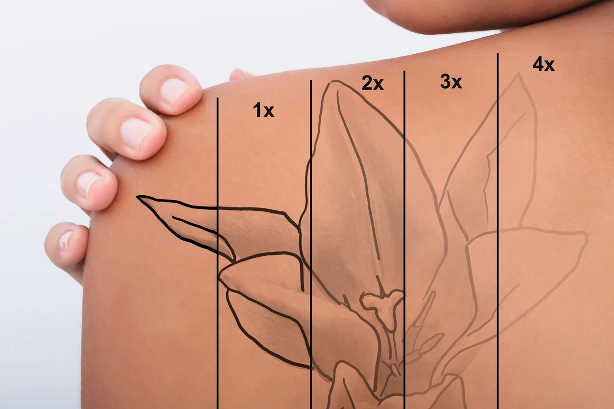 Tattoo removal progress showing fading over multiple sessions